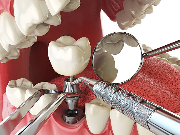 Best Emergency Dentist for Lost Fillings or Crowns in Kaysville, UT