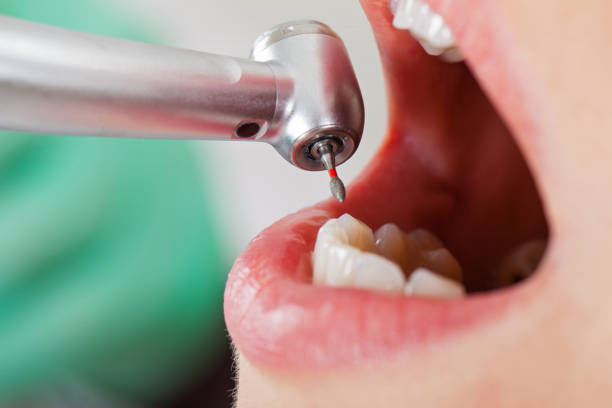 Best Emergency Root Canal Treatment in Kaysville, UT